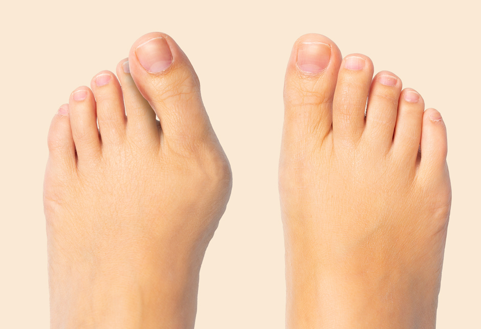 痛い靴を履き続けると 足の形が変わる 外反母趾 がいはんぼし になる前に その危険性を知ろう 足の美容 健康 Shoetreeシューツリー 女性を足元から応援するwebマガジン